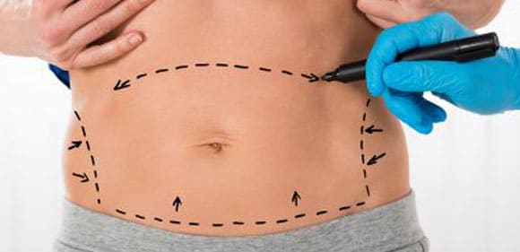 Tummy Tuck Result is permanent ?